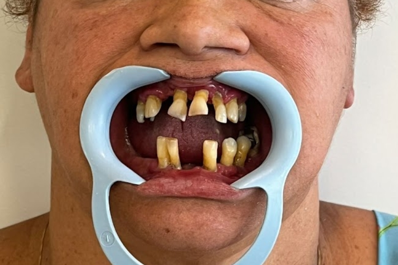 Antes - Implante Dentário