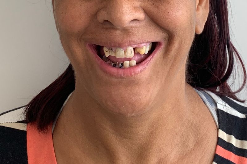 Antes - Implante Dentário